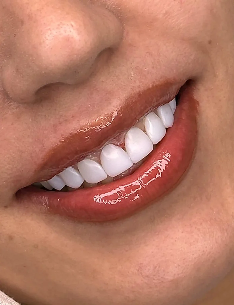 عکس از اتمام کار لمینت دندان توسط دکتر عظیم زاده