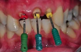 عصب کشی در دندانپزشکی دکتر عظیم زاده
