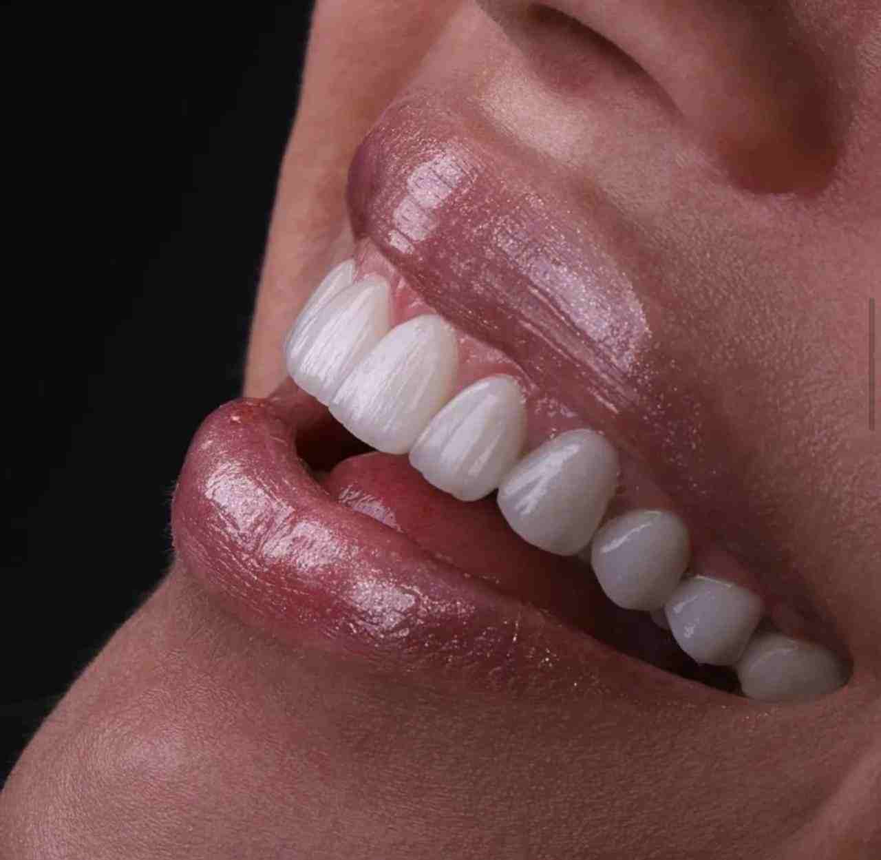 لمینت در دندانپزشکی دکتر عظیم زاده