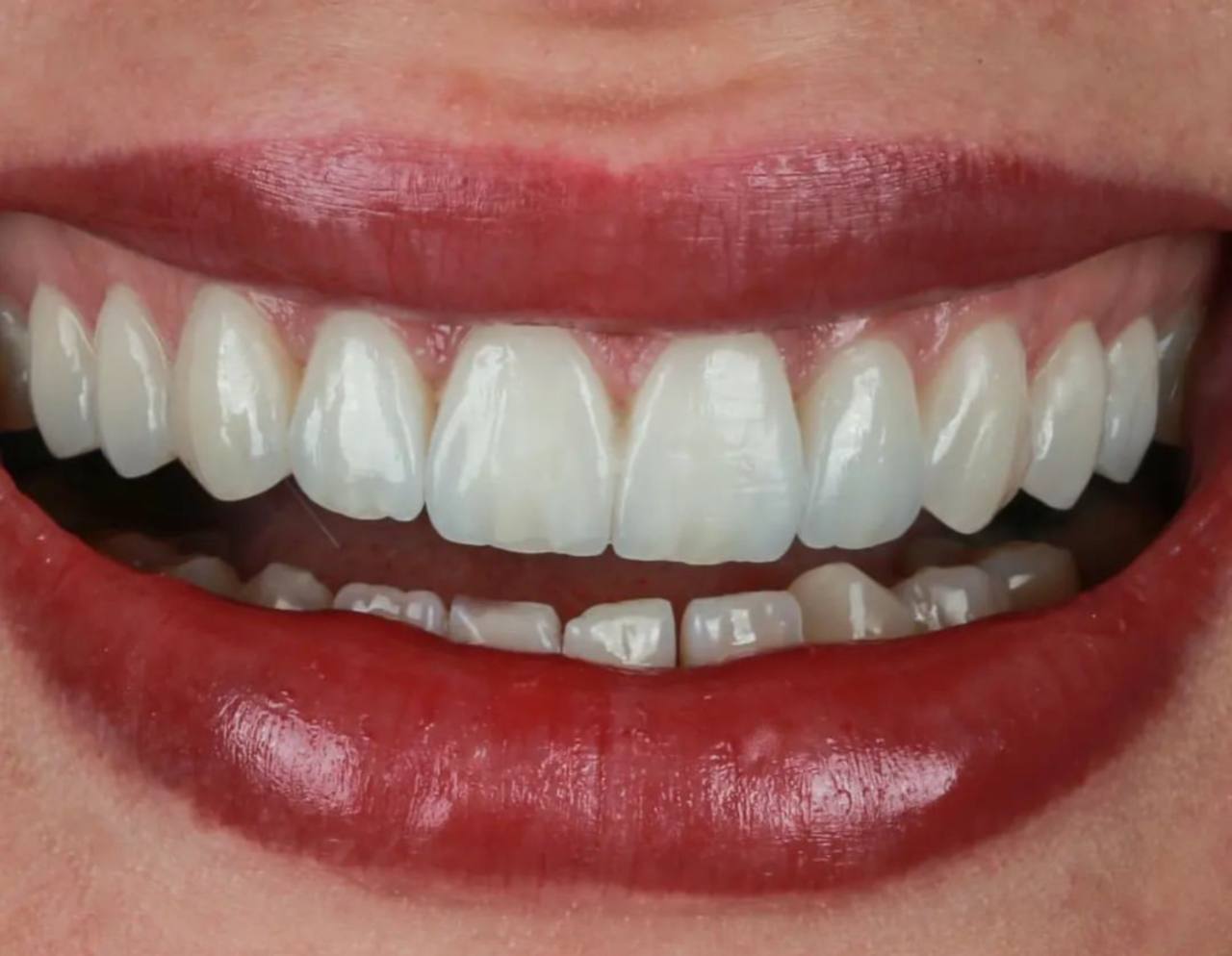 لمینت در دندانپزشکی دکتر عظیم زاده