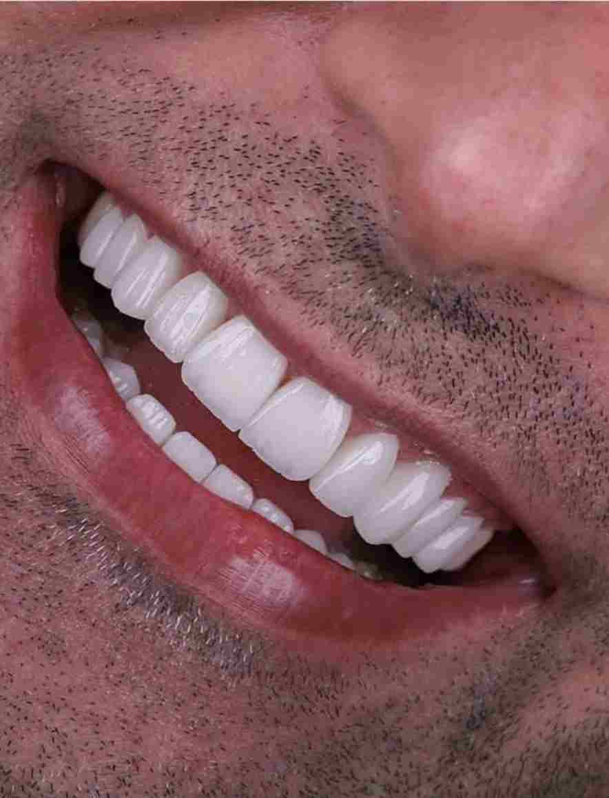 لمینت در دندانپزشکی دکتر عظیم زاده